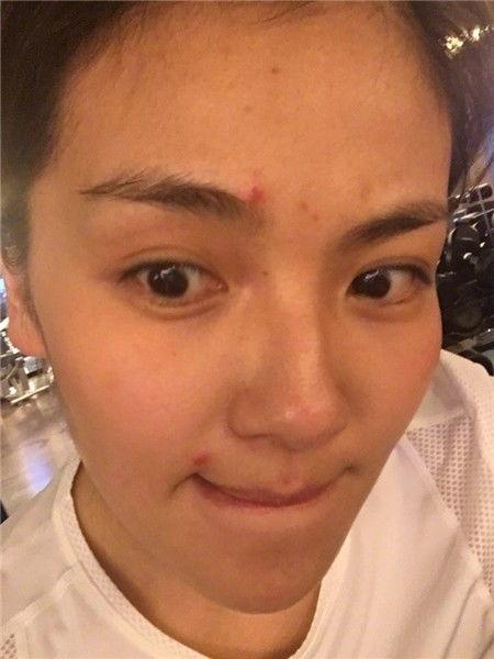 明星长痘痘的照片,痘痘无惧镜头，真实肌肤状态引关注