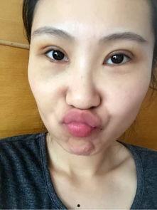 手术后可以吃瓜么